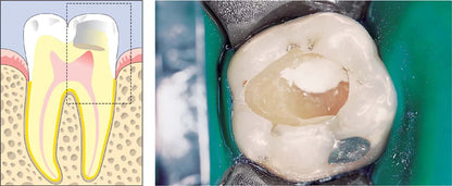 SafeEndo ReGlass LC mdental