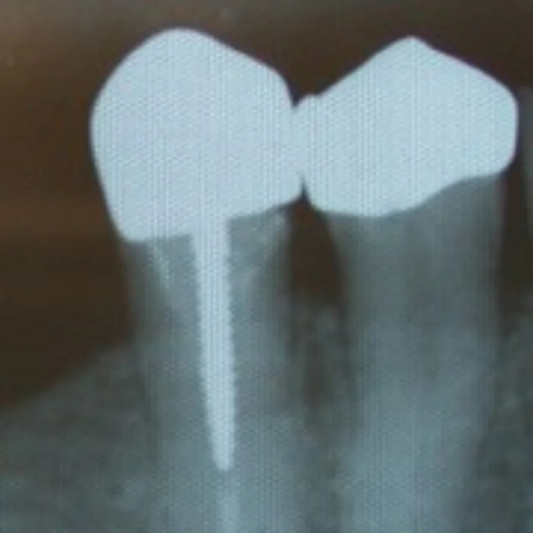 Angelus Reforpost Metallic - Intraradicular Posts mdental
