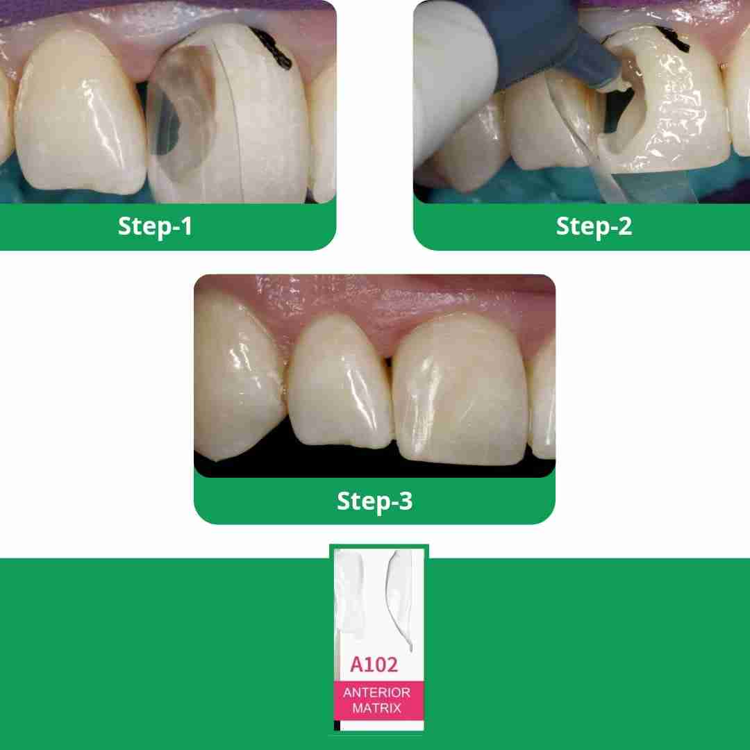 Bioclear Anterior Kit - Modern Matrix System for Esthetic Restorations mdental