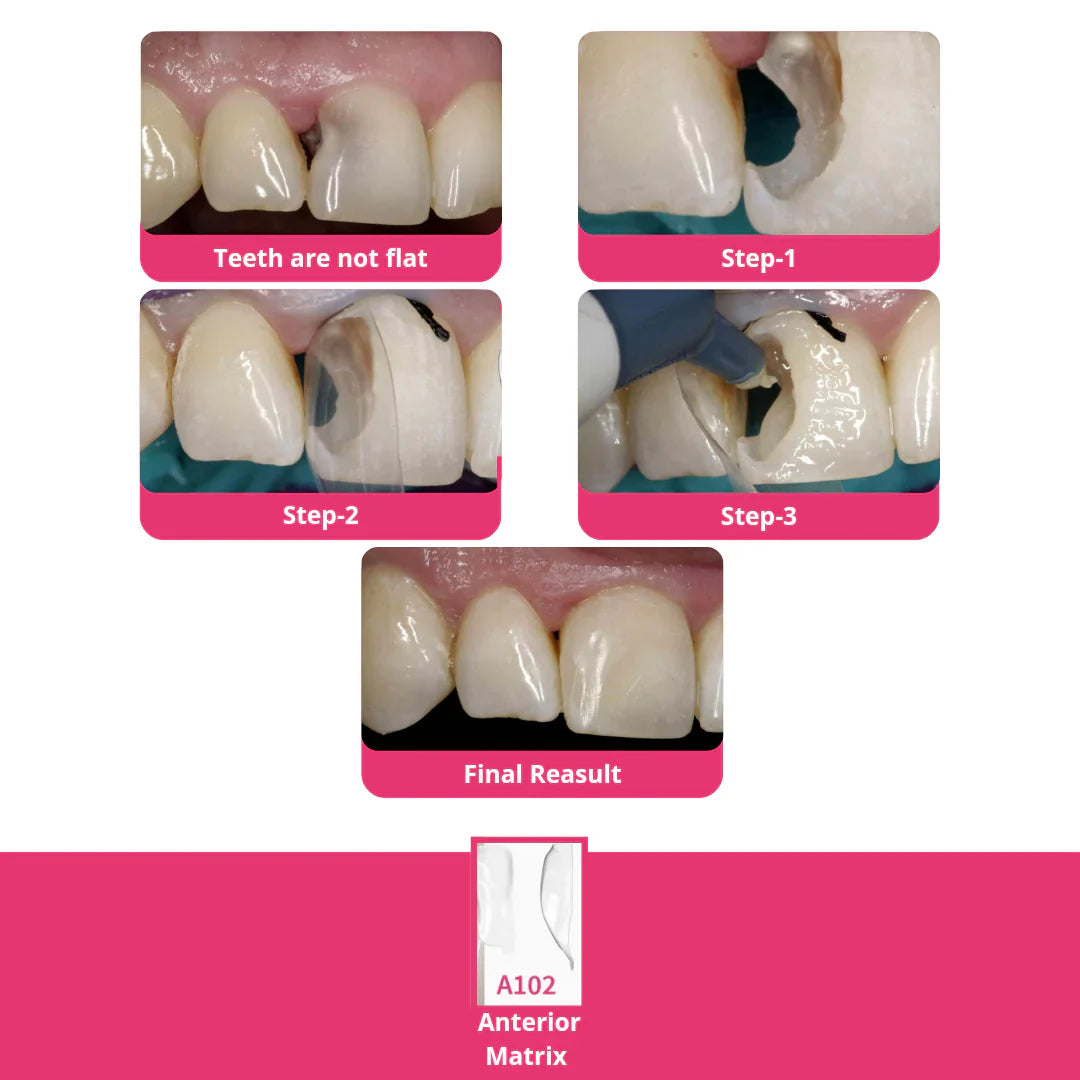 Bioclear Anterior Matrix - Clear Anatomical Sectional Matrices mdental