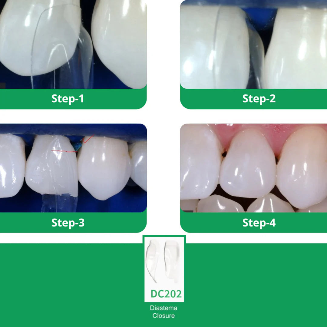 Bioclear Anterior Matrix – Diastema Closure Series mdental