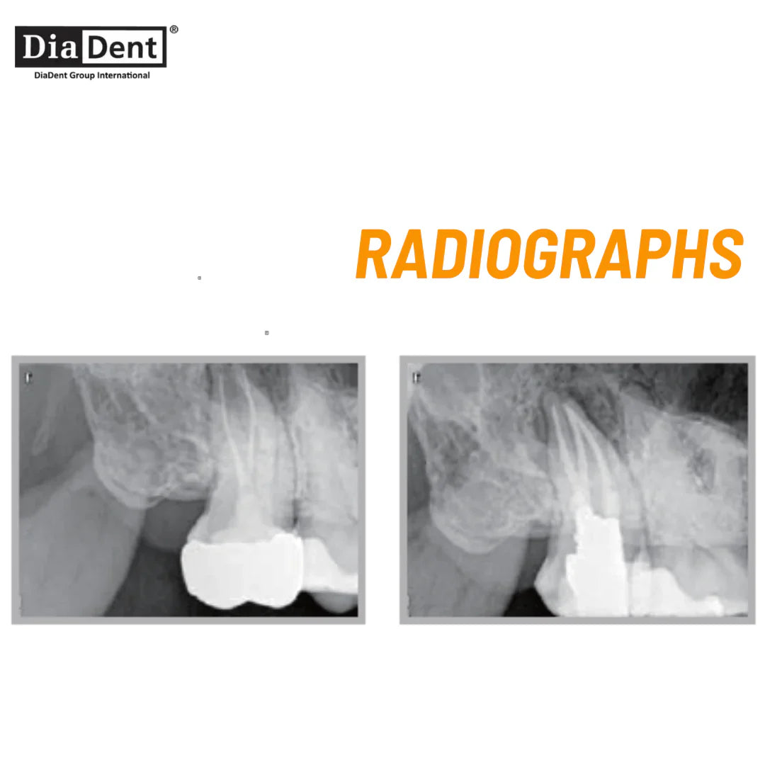 DiaDent DiaProseal - Epoxy Resin Based Root Canal Sealer mdental