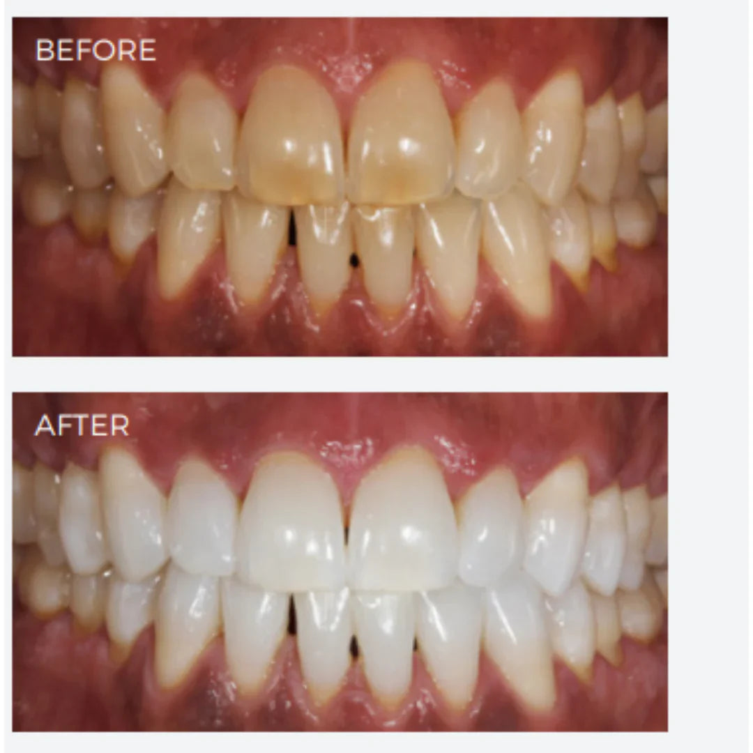 SDI Pola Office+ - Tooth Whitening System mdental