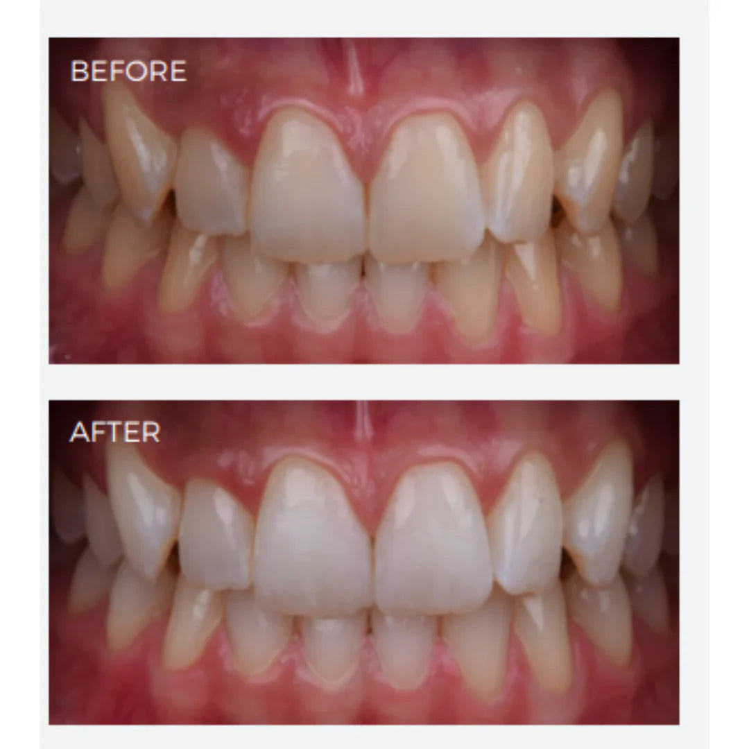 SDI Pola Office - Tooth Whitening System mdental