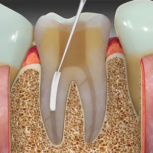 SafeEndo BioActive RCS mdental