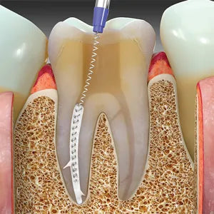 SafeEndo BioActive RCS mdental