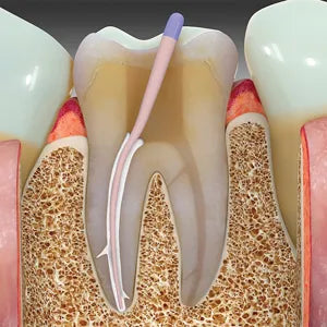 SafeEndo EugeSeal mdental