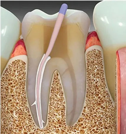 SafeEndo EpoxySeal mdental