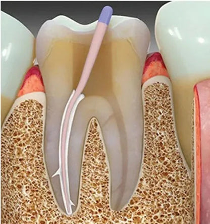 SafeEndo EpoxySeal mdental